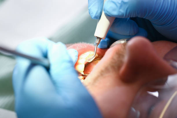 Best Emergency Treatment for Dental Infections or Abscesses in Pleasant Grove, AL